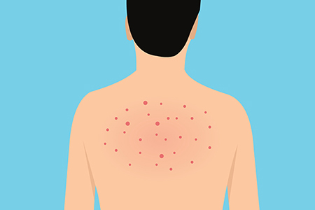 背部湿疹的症状是什么样子的